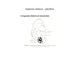 Aspectos clínicos - glicólise
1) Isquemia (Infarto do miocárdio):
 