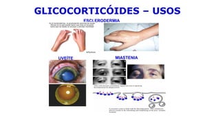 ESCLERODERMIA
UVEÍTE MIASTENIA
GLICOCORTICÓIDES – USOS
 