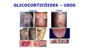 PÊNFIGO LIQUEN
GLICOCORTICÓIDES – USOS
 