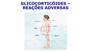 GLICOCORTICÓIDES –
REAÇÕES ADVERSAS
 