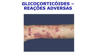 GLICOCORTICÓIDES –
REAÇÕES ADVERSAS
 