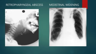 RETROPHARYNGEAL ABSCESS MEDISTINAL WIDENING
 