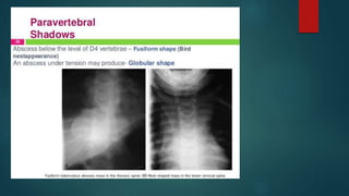 Birds nest abscess Psoas Abscess
 