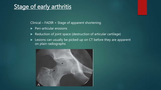 Clinical – FADIR + Stage of apparent shortening
 Peri-articular erosions
 Reduction of joint space (destruction of articular cartilage)
 Lesions can usually be picked up on CT before they are apparent
on plain radiographs
Stage of early arthritis
 
