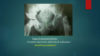 Stage of advanced arthritis -
Complete destruction, deformity & subluxation
Wandering acetabulum
 