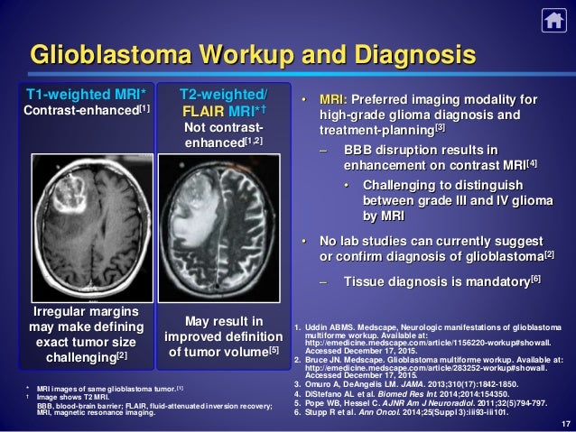 Glioblastoma vibhay