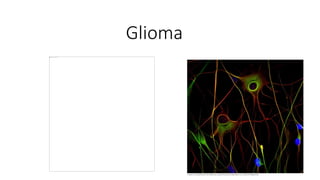 Glioma
 