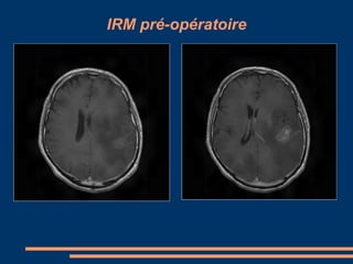 IRM pré-opératoire 