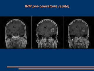 IRM pré-opératoire (suite) 
