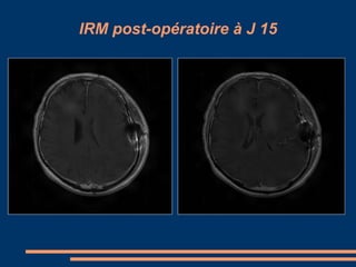 IRM post-opératoire à J 15 