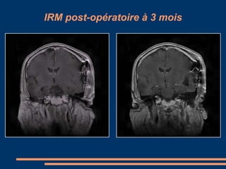 IRM post-opératoire à 3 mois 