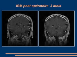 IRM post-opératoire  3 mois 
