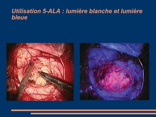 Utilisation 5-ALA : lumière blanche et lumière bleue 