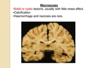 Macroscopy
•Solid or cystic lesions, usually with little mass effect.
•Calcification
•Haemorrhage and necrosis are rare.
 