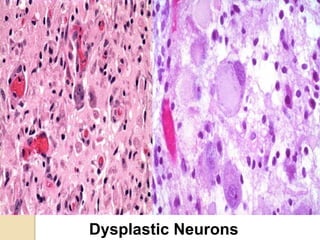 Dysplastic Neurons
 