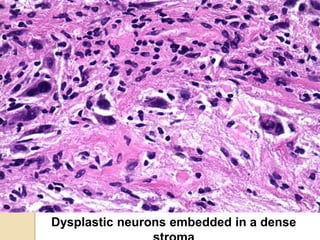 Dysplastic neurons embedded in a dense
 
