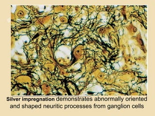Silver impregnation demonstrates abnormally oriented
and shaped neuritic processes from ganglion cells
 