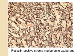 Reticulin-positive stroma maybe quite exuberant
 