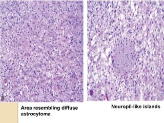 Area resembling diffuse
astrocytoma
Neuropil-like islands
 