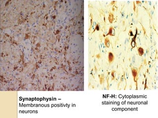 Synaptophysin –
Membranous positivty in
neurons
NF-H: Cytoplasmic
staining of neuronal
component
 