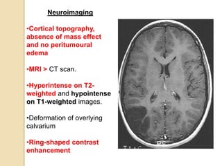 Neuroimaging
•Cortical topography,
absence of mass effect
and no peritumoural
edema
•MRI > CT scan.
•Hyperintense on T2-
weighted and hypointense
on T1-weighted images.
•Deformation of overlying
calvarium
•Ring-shaped contrast
enhancement
 