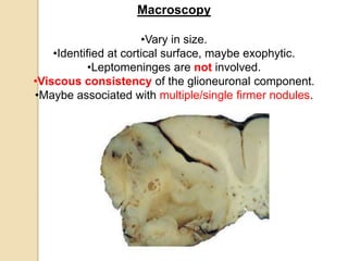 Macroscopy
•Vary in size.
•Identified at cortical surface, maybe exophytic.
•Leptomeninges are not involved.
•Viscous consistency of the glioneuronal component.
•Maybe associated with multiple/single firmer nodules.
 