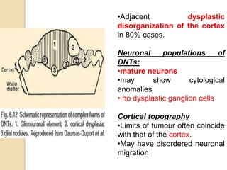 •Adjacent dysplastic
disorganization of the cortex
in 80% cases.
Neuronal populations of
DNTs:
•mature neurons
•may show cytological
anomalies
• no dysplastic ganglion cells
Cortical topography
•Limits of tumour often coincide
with that of the cortex.
•May have disordered neuronal
migration
 