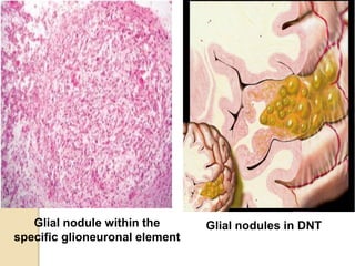 Glial nodule within the
specific glioneuronal element
Glial nodules in DNT
 