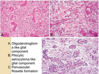 A. Oligodendrogliom
a like glial
component
B. Pilocytic
astrocytoma like
glial component
C.Perivascular
Rosette formation
 