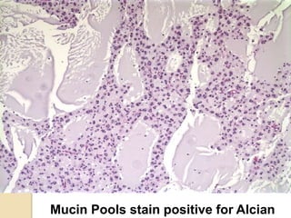 Mucin Pools stain positive for Alcian
 