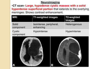 Neuroimaging
•CT scan- Large, hypodense cystic masses with a solid
hyperdense superficial portion that extends to the overlying
meninges. Shows contrast enhancement.
MRI T1-weighted images T2-weghted
images
Solid
component
Isointense, peripheral,
enhancing
Heterogenous
Cystic
component
Hypointense Hyperintense
 