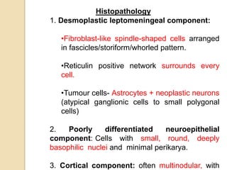 Histopathology
1. Desmoplastic leptomeningeal component:
•Fibroblast-like spindle-shaped cells arranged
in fascicles/storiform/whorled pattern.
•Reticulin positive network surrounds every
cell.
•Tumour cells- Astrocytes + neoplastic neurons
(atypical ganglionic cells to small polygonal
cells)
2. Poorly differentiated neuroepithelial
component: Cells with small, round, deeply
basophilic nuclei and minimal perikarya.
3. Cortical component: often multinodular, with
 