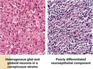 Heterogenous glial and
globoid neurons in a
conspicuous stroma
Poorly differentiated
neuroepithelial component
 