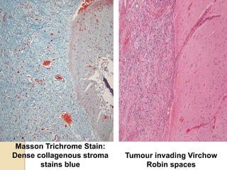 Tumour invading Virchow
Robin spaces
Masson Trichrome Stain:
Dense collagenous stroma
stains blue
 