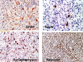 GFAP
Synaptophysin
NeuN
Reticulin
 