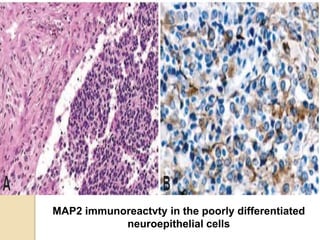 MAP2 immunoreactvty in the poorly differentiated
neuroepithelial cells
 