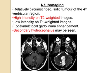 Neuromaging
•Relatively circumscribed, solid tumour of the 4th
ventricular region.
•High intensity on T2-weighted images.
•Low intensity on T1-weighted images.
•Focal/multifocal gadolinium enhancement.
•Secondary hydrocephalus may be seen.
 
