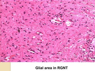 Glial area in RGNT
 