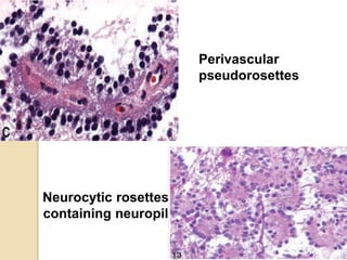 Neurocytic rosettes
containing neuropil
Perivascular
pseudorosettes
 