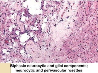 Biphasic neurocytic and glial components;
neurocytic and perivascular rosettes
 