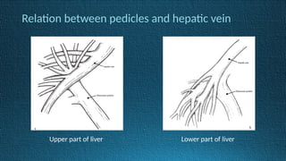 Relation between pedicles and hepatic vein
Upper part of liver Lower part of liver
 