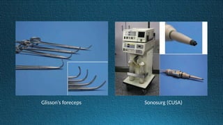 Glisson’s foreceps Sonosurg (CUSA)
 