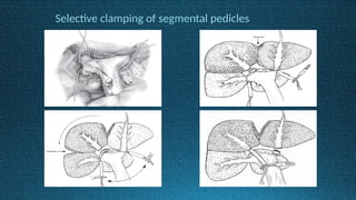 Selective clamping of segmental pedicles
 