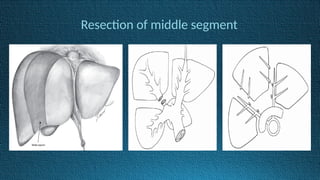 Resection of middle segment
 