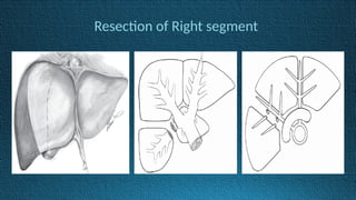 Resection of Right segment
 