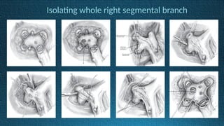 Isolating whole right segmental branch
 