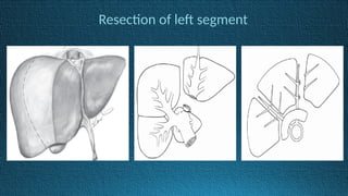 Resection of left segment
 