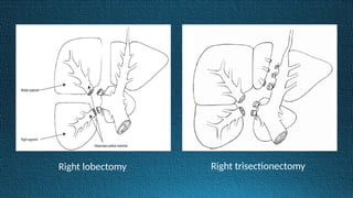 Right lobectomy Right trisectionectomy
 