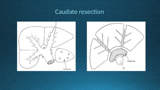 Caudate resection
 