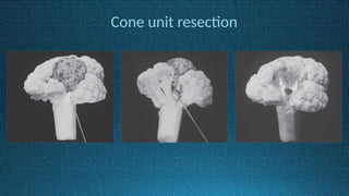 Cone unit resection
 